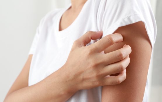 Nesselsucht (Urtikaria)